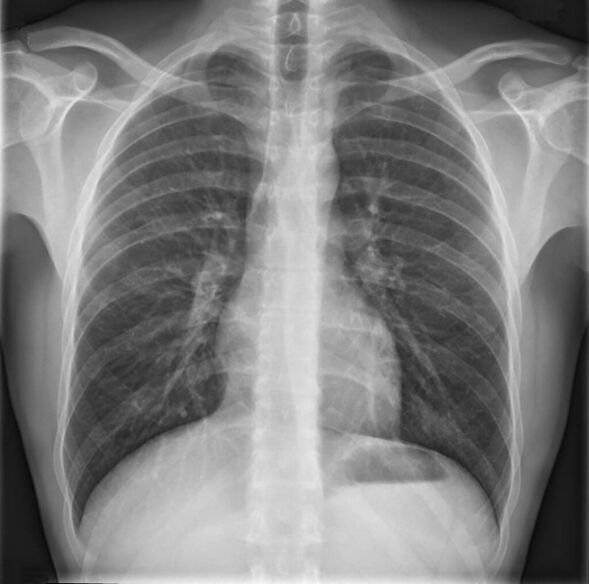 Osteochondrose van de thoracale wervelkolom wordt gediagnosticeerd met behulp van radiografie