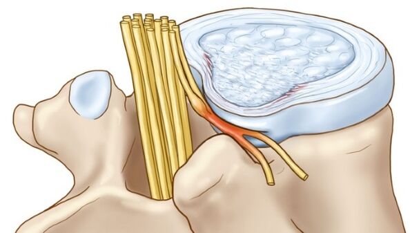Uitsteeksels van de tussenwervelschijf die optreden bij thoracale osteochondrose drukken de zenuwuiteinden samen