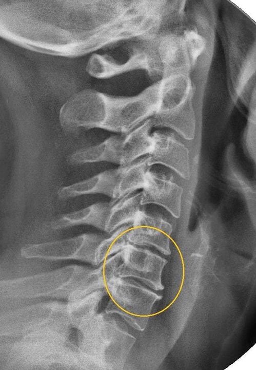 osteochondrose