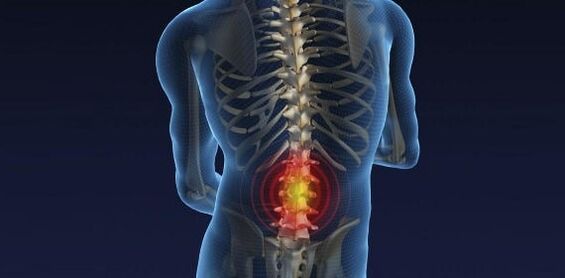 Rugpijn met osteochondrose van de lumbale
