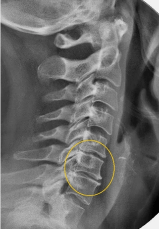 Osteochondrose van de cervicale wervelkolom op een X -RAY
