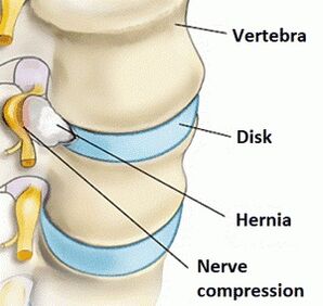 Osteochondrose van het cervicale gebied