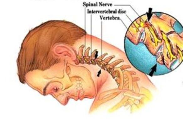 cervicale osteochondrose