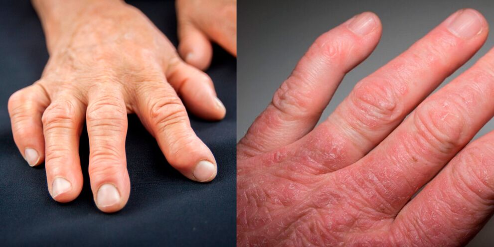 reumatoïde en psoriatische artritis van de handen