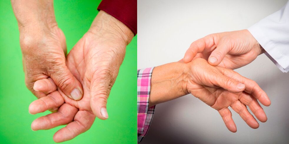 zwelling en pijn zijn de eerste tekenen van handartritis