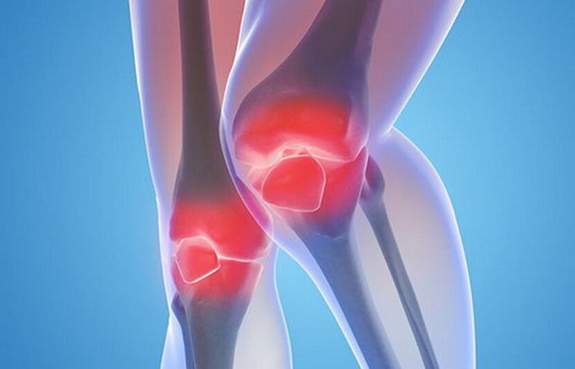 artrose van de kniegewrichten