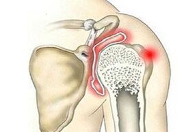 vernietiging van het schoudergewricht met artrose
